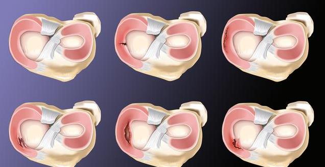 易受累, AA 易受累, AA